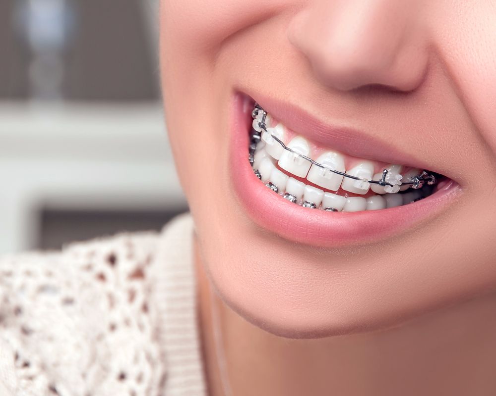 Are braces in Vietnam covered by health insurance?